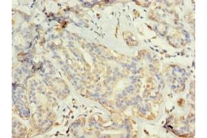 Immunohistochemistry of paraffin-embedded human breast cancer using ABIN7173703 at dilution of 1:100 (TUBG2 Antikörper  (AA 276-451))