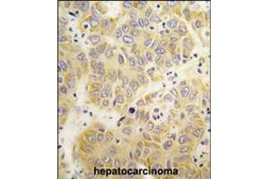 Formalin-fixed and paraffin-embedded human hepatocarcinoma tissue reacted with the VARS antibody , which was peroxidase-conjugated to the secondary antibody, followed by DAB staining. (VARS Antikörper  (N-Term))