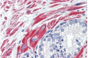 Human Prostate (formalin-fixed, paraffin-embedded) stained with SSX4 antibody ABIN462200 followed by biotinylated goat anti-rabbit IgG secondary antibody ABIN481713, alkaline phosphatase-streptavidin and chromogen. (SSX4 Antikörper  (AA 108-157))