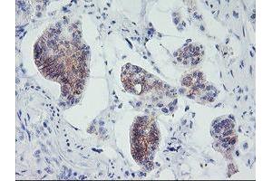 Immunohistochemical staining of paraffin-embedded Carcinoma of Human pancreas tissue using anti-MLF1 mouse monoclonal antibody. (MLF1 Antikörper)