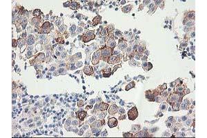 Immunohistochemical staining of paraffin-embedded Carcinoma of Human lung tissue using anti-FAM119A mouse monoclonal antibody. (FAM119A Antikörper)