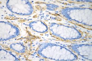 Immunohistochemistry was performed on paraffin-embedded human sigmoid colon carcinoma using caveolin 1 antibody (ABIN7797944), 1:200). (Rekombinanter Caveolin-1 Antikörper)