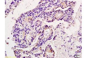 Formalin-fixed and paraffin embedded human colon carcinoma labeled with Anti-MMP9 Polyclonal Antibody, Unconjugated  at 1:200 followed by conjugation to the secondary antibody and DAB staining. (MMP 9 Antikörper  (AA 151-250))