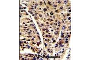 Formalin-fixed and paraffin-embedded human hepatocarcinoma reacted with ENOB Antibody (Center), which was peroxidase-conjugated to the secondary antibody, followed by DAB staining. (ENO3 Antikörper  (AA 237-264))