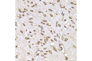 Immunohistochemistry of paraffin-embedded human colon carcinoma using LMNB2 Antibody (ABIN5973877) at dilution of 1/200 (40x lens). (Lamin B2 Antikörper)