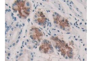 Detection of KARS in Human Stomach cancer Tissue using Polyclonal Antibody to Lysyl tRNA Synthetase (KARS) (KARS Antikörper  (AA 323-553))