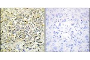 Immunohistochemistry analysis of paraffin-embedded human lung carcinoma tissue, using CDKL4 Antibody. (CDKL4 Antikörper  (AA 266-315))