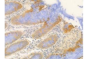 ABIN6259081 and ABIN6273900 at 1/100 staining human colon carcinoma by IHC-P.