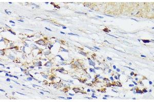 Immunohistochemistry of paraffin-embedded Human gastric cancer using TREM2 Polyclonal Antibody at dilution of 1:200 (40x lens). (TREM2 Antikörper)