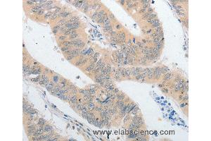 Immunohistochemistry of Human colon cancer using PPAP2A Polyclonal Antibody at dilution of 1:40 (PLPP1 Antikörper)