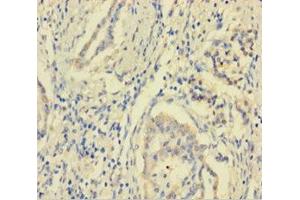 Immunohistochemistry of paraffin-embedded human pancreatic cancer using ABIN7158949 at dilution of 1:100