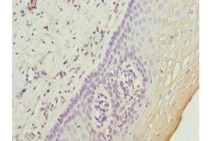 Immunohistochemistry of paraffin-embedded human cervical cancer using ABIN7174639 at dilution of 1:100 (UGT2B10 Antikörper  (AA 20-280))