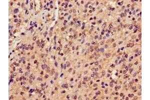 Immunohistochemistry of paraffin-embedded human glioma using ABIN7162945 at dilution of 1:100 (Peroxiredoxin 6 Antikörper  (AA 87-224))