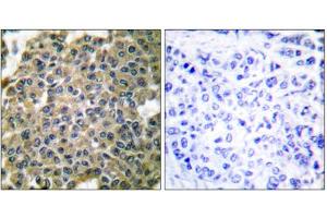 Immunohistochemical analysis of paraffin-embedded human breast carcinoma tissue using Keratin 7 antibody (ABIN5976442). (Cytokeratin 7 Antikörper  (C-Term))