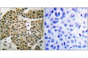 Immunohistochemistry analysis of paraffin-embedded human breast carcinoma tissue, using NF-kappaB p105/p50 (Ab-927) Antibody. (NFKB1 Antikörper  (AA 896-945))