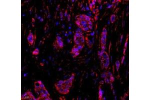 Immunofluorescence of paraffin embedded human breast cancer using DDX19B (ABIN7073694) at dilution of 1: 650 (400x lens) (DDX19B Antikörper)