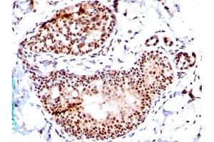 Formalin-fixed, paraffin-embedded human Breast Carcinoma stained with SUMO-1 Mouse Monoclonal Antibody (SM1/495) (SUMO1 Antikörper)