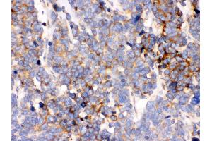 Anti- GRP78 BiP Picoband antibody, IHC(P) IHC(P): Human Lung Cancer Tissue