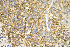 Immunohistochemistry was performed on paraffin-embedded human glioblastoma using creatine kinase B antibody (ABIN7798163), 1:200). (Rekombinanter CKB Antikörper)