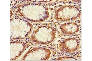 Immunohistochemistry of paraffin-embedded human colon cancer using ABIN7172166 at dilution of 1:100 (CCDC59 Antikörper  (AA 1-241))