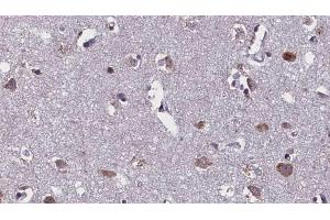 ABIN6268712 at 1/100 staining Human brain cancer tissue by IHC-P. (Aquaporin 4 Antikörper  (Internal Region))