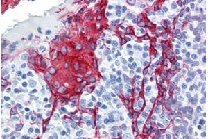 Human Tonsil (formalin-fixed, paraffin-embedded) stained with KRT13 antibody ABIN364278 at 10 ug/ml followed by biotinylated anti-mouse IgG secondary antibody ABIN481714, alkaline phosphatase-streptavidin and chromogen. (Cytokeratin 13 Antikörper)