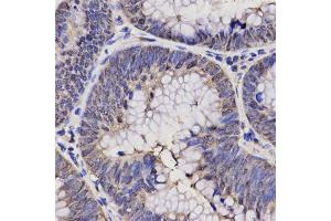 Immunohistochemistry of paraffin-embedded human rectal cancer using NPPA antibody (ABIN5970781) at dilution of 1/200 (40x lens). (NPPA Antikörper)