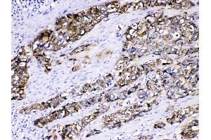 Cytokeratin 5 was detected in paraffin-embedded sections of human oesophagus squama cancer tissues using rabbit anti- Cytokeratin 5 Antigen Affinity purified polyclonal antibody (Catalog # ) at 1 µg/mL.