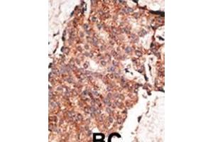 Formalin-fixed and paraffin-embedded human cancer tissue reacted with the primary antibody, which was peroxidase-conjugated to the secondary antibody, followed by AEC staining. (BMP1 Antikörper  (C-Term))