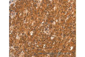 Immunohistochemistry of Human thyroid cancer using DAB2IP Polyclonal Antibody at dilution of 1:40
