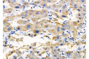 ABIN6257437 and ABIN6275374 at 1/100 staining Human liver cancer by IHC-P.