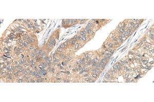 Immunohistochemistry of paraffin-embedded Human gastric cancer tissue using CA7 Polyclonal Antibody at dilution of 1:50(x200) (CA7 Antikörper)