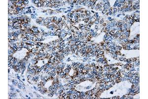 Immunohistochemical staining of paraffin-embedded Adenocarcinoma of breast tissue using anti-ATP5B mouse monoclonal antibody. (ATP5B Antikörper)