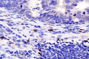 Immunohistochemistry analysis of paraffin-embedded human colon cancer using TCRb (ABIN7075813) at dilution of 1: 1800 (TCRb Antikörper)