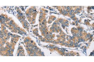 Immunohistochemistry of paraffin-embedded Human breast cancer tissue using CAMK4 Polyclonal Antibody at dilution 1:40