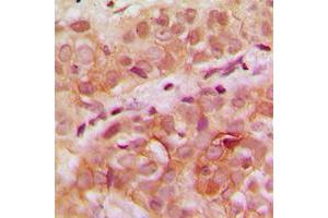 Immunohistochemical analysis of WDHD1 staining in human breast cancer formalin fixed paraffin embedded tissue section.