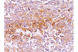 Formalin-fixed, paraffin-embedded human melanoma stained with gp100 / Melanosome Mouse Monoclonal Antibody (NKI-beteb). (Melanoma gp100 Antikörper)