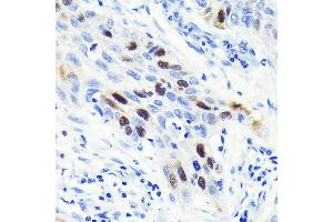 Immunohistochemistry of paraffin-embedded human lung cancer using Cyclin  Rabbit mAb (ABIN7266551) at dilution of 1:100 (40x lens). (Cyclin A Antikörper)