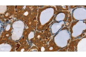 Immunohistochemistry of paraffin-embedded Human thyroid cancer using RAB27A Polyclonal Antibody at dilution of 1:30 (RAB27A Antikörper)
