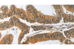 Immunohistochemistry of paraffin-embedded Human colon cancer tissue using PIK3R3 Polyclonal Antibody at dilution 1:45 (PIK3R3 Antikörper)