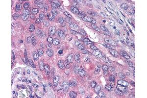 Anti-PLK1 antibody IHC of human lung carcinoma. (PLK1 Antikörper  (pThr210))
