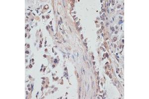 Immunohistochemistry of paraffin-embedded human lung cancer using NCO antibody  at dilution of 1:100 (40x lens). (NCOA4 Antikörper  (AA 495-614))