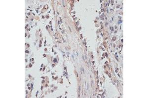 Immunohistochemistry of paraffin-embedded human lung cancer using NCO antibody  at dilution of 1:100 (40x lens). (NCOA4 Antikörper  (AA 495-614))