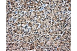 Immunohistochemical staining of paraffin-embedded Adenocarcinoma of colon tissue using anti-RDH11 mouse monoclonal antibody.