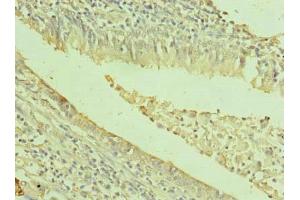 Immunohistochemistry of paraffin-embedded human lung cancer using ABIN7171996 at dilution of 1:100 (TXNDC11 Antikörper  (AA 656-985))