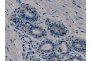 Detection of MMP9 in Human Breast cancer Tissue using Monoclonal Antibody to Matrix Metalloproteinase 9 (MMP9)