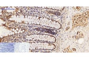 Immunohistochemistry of paraffin-embedded Human colon tissue using Phospho-PI 3 kinase p85 alpha /gamma (Tyr467/199) Polyclonal Antibody at dilution of 1:200 (PI3K p85 alpha/gamma Antikörper  (pTyr199, pTyr467))