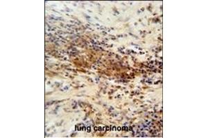 DNAJC11 antibody (N-term) (ABIN654437 and ABIN2844172) immunohistochemistry analysis in formalin fixed and paraffin embedded human lung carcinoma followed by peroxidase conjugation of the secondary antibody and DAB staining. (DNAJC11 Antikörper  (N-Term))