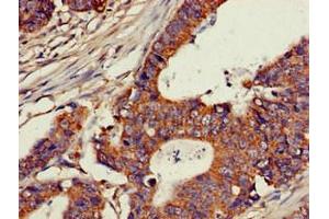 Immunohistochemistry of paraffin-embedded human colon cancer using ABIN7147600 at dilution of 1:100 (CH25H Antikörper  (AA 142-272))