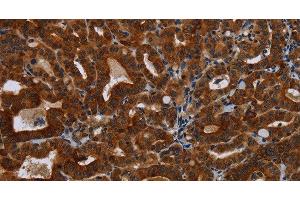 Immunohistochemistry of paraffin-embedded Human thyroid cancer tissue using KLHL1 Polyclonal Antibody at dilution 1:30